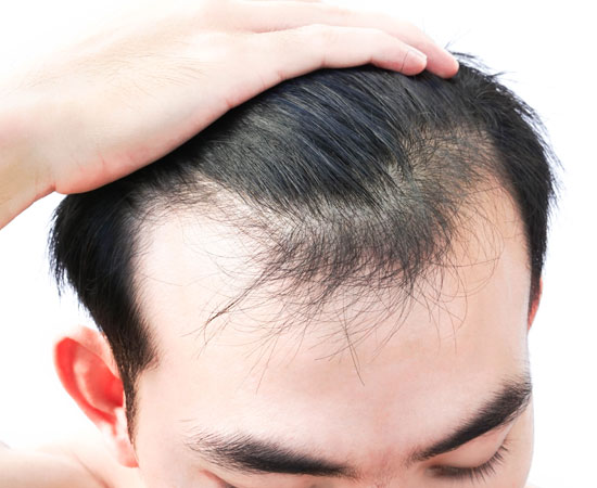 best prp injections hair restoration Los Angeles