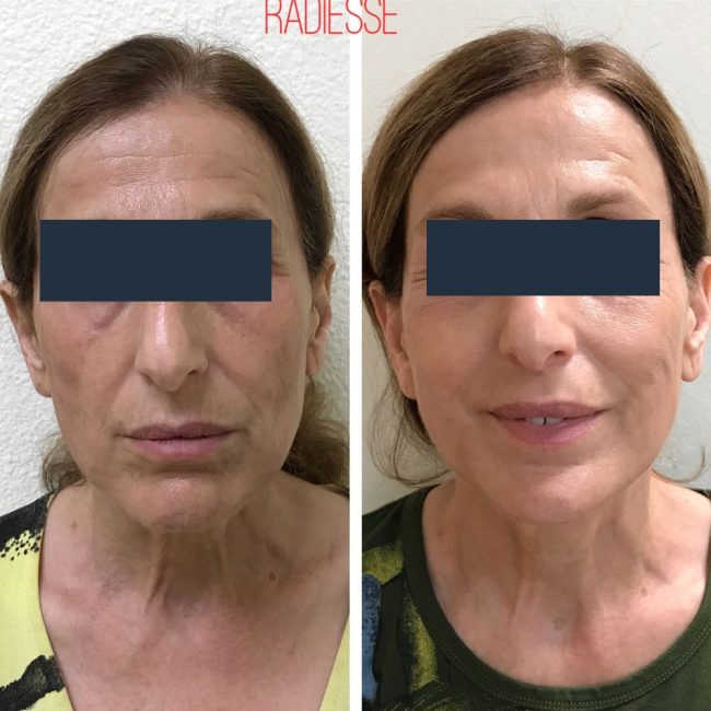 La Best Dermal Fillers Happy Hands Aesthetics Before After Radiesse