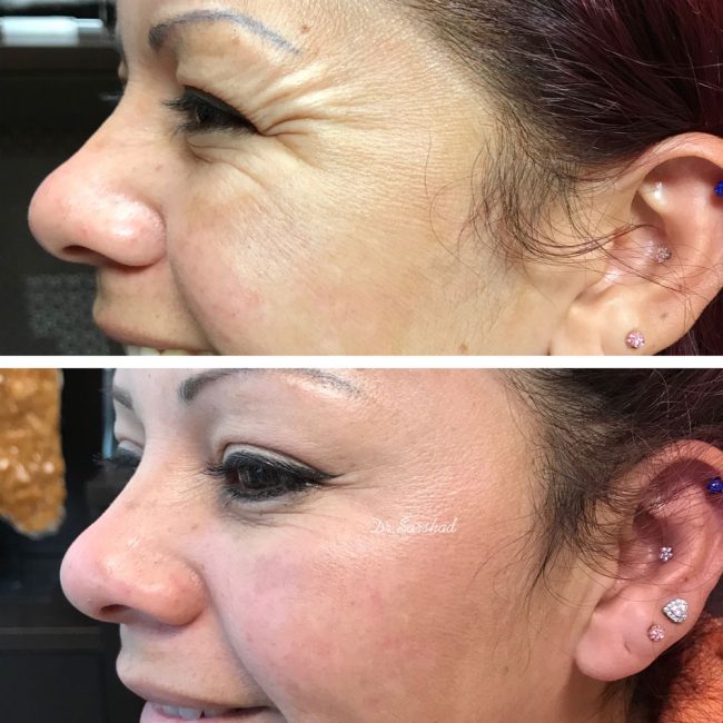 La Best Dermal Fillers Happy Hands Aesthetics Before After Xeomin