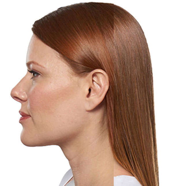 After-Kybella Injections