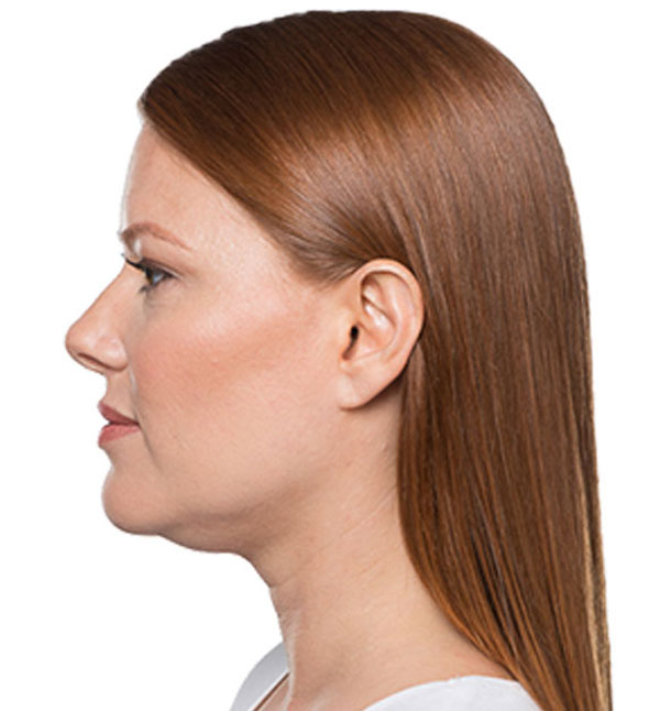 Before-Kybella Injections