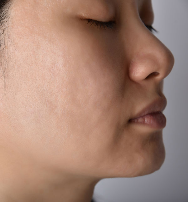 After-PRP Microneedling