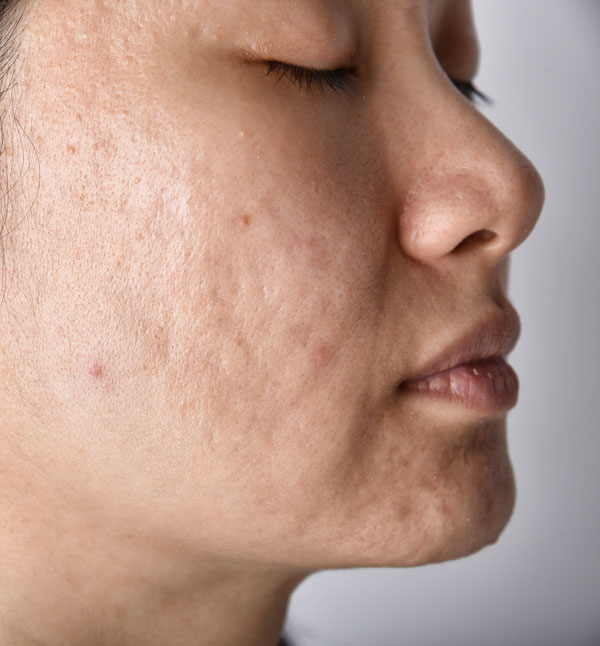 Before-PRP Microneedling