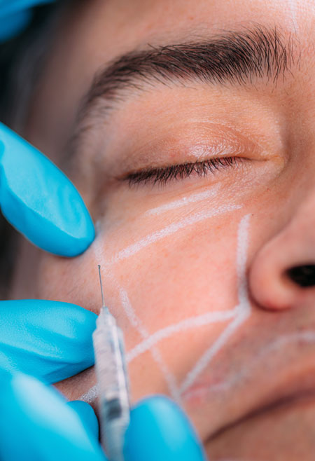 La Best Dermal Fillers Cheek Fillers