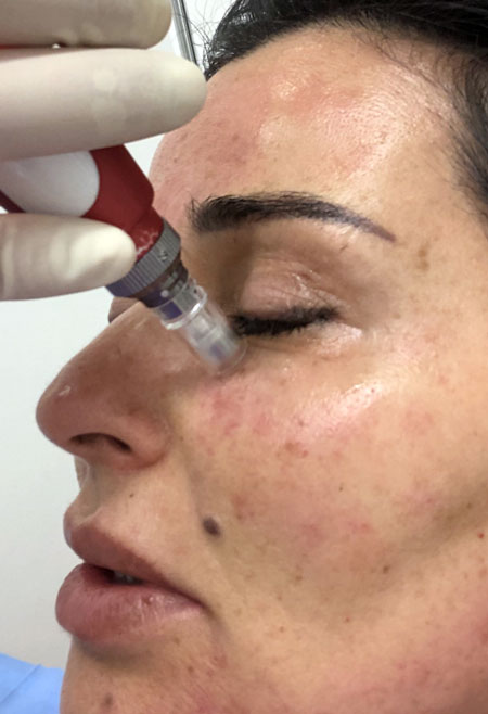 La Best Dermal Fillers Microneedling