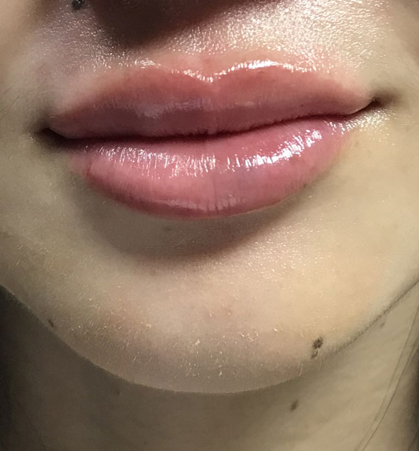 After-Lip Fillers