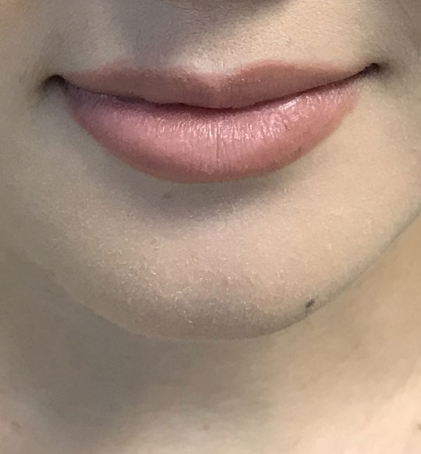 Before-Lip Fillers