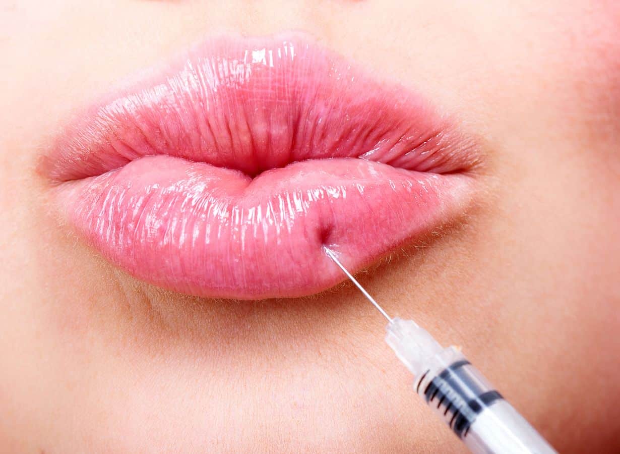 dermal fillers injection