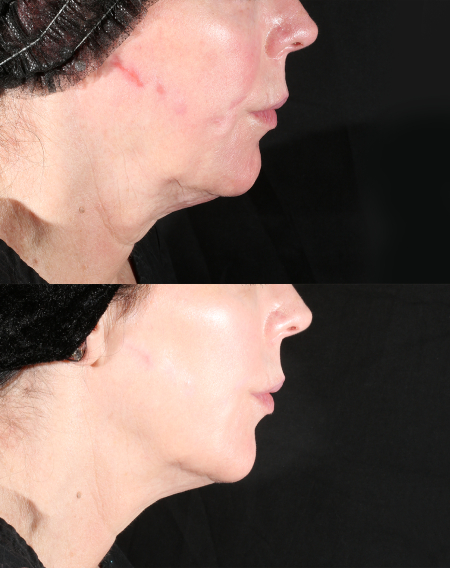 xerf laser skin tightening xerf laser skin tightening