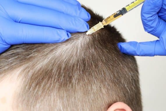 what should expect during after prp hair restoration