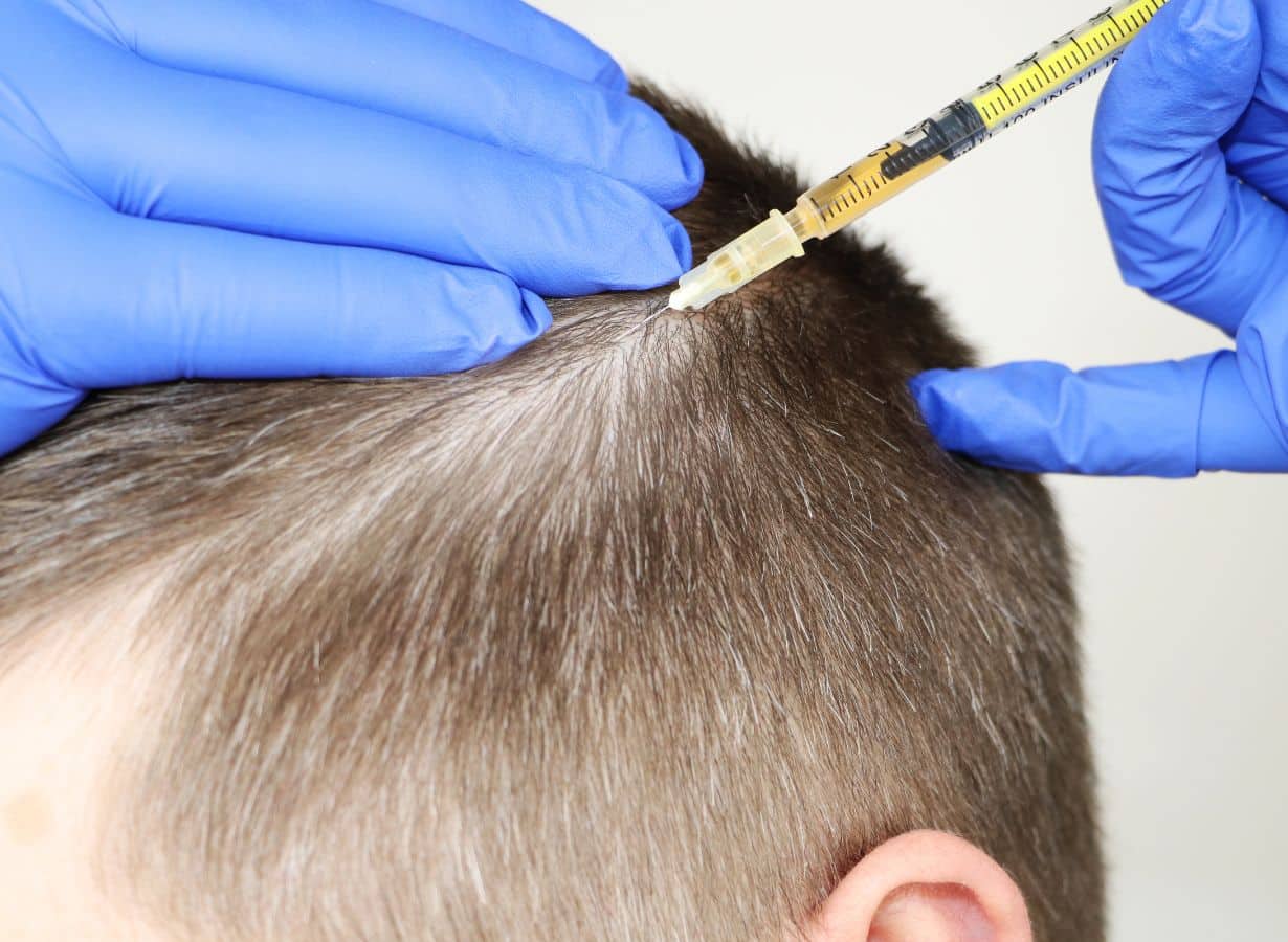 what should expect during after prp hair restoration
